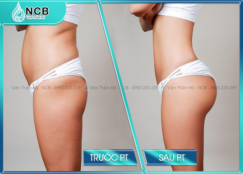 Hình ảnh hút mỡ trước sau