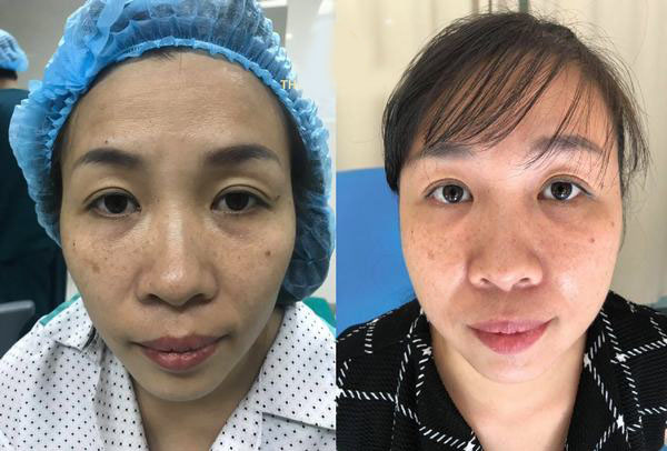 Cấy mỡ thái dương Ultra Fat