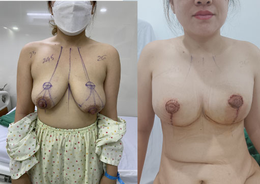 Thu Gọn Núm Vú